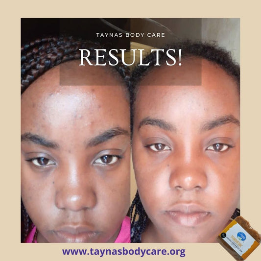 How the holidays impact the wellbeing of your skin!